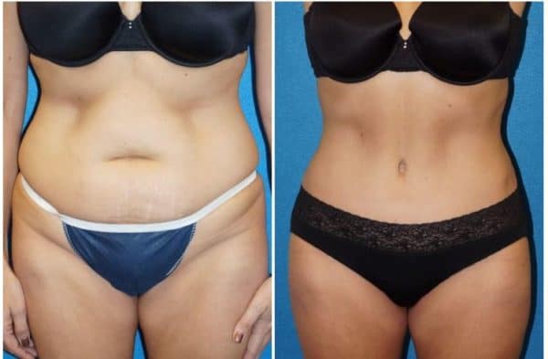 How Much Does a Tummy Tuck Cost? - Dr Rudy Coscia